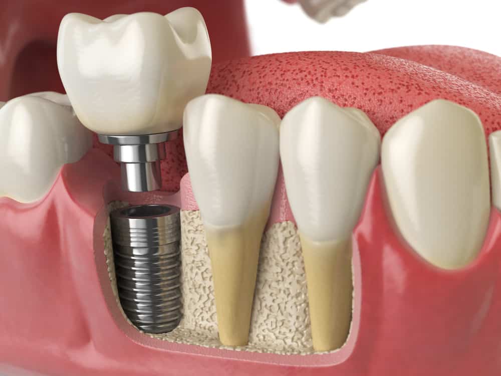 dental implants vs dentures vs bridges comparison guide tooth replacement options
